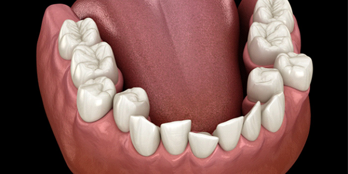 Illustration of crowded teeth