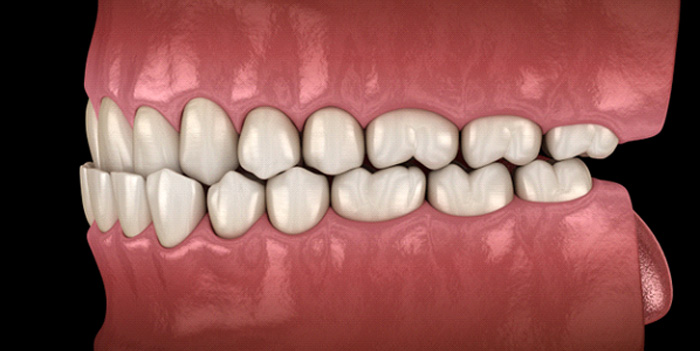 Illustration of an underbite