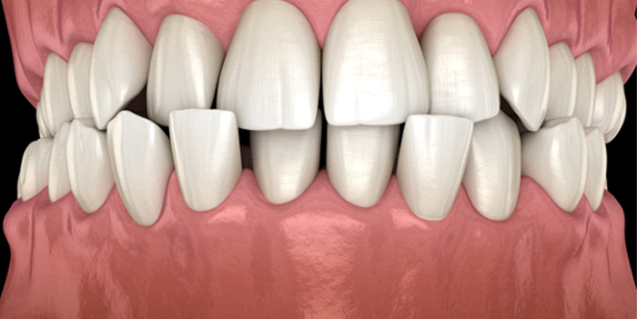 Illustration of a crossbite