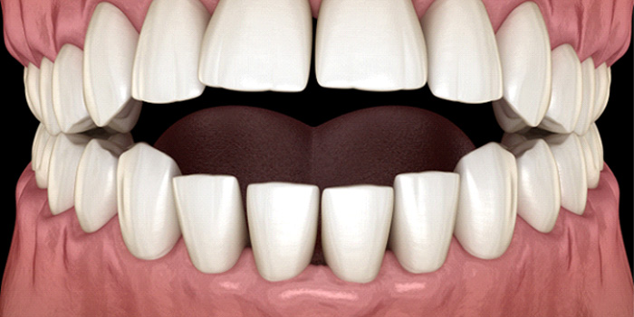 Illustration of an open bite