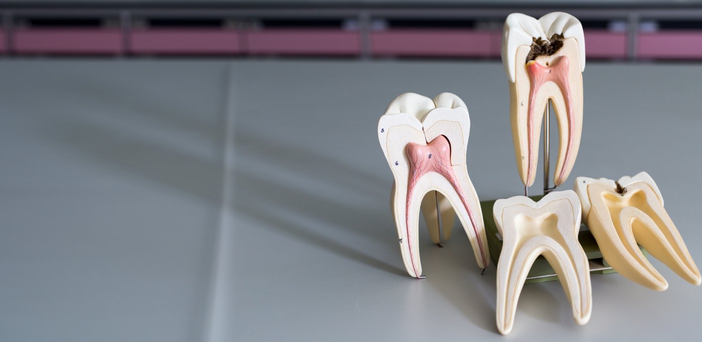 Several models of decayed teeth that need root canal treatment in Baytown