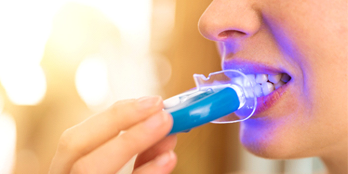 Patient in Baytown using at-home whitening